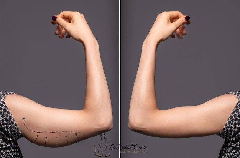 Benefits of arm lift-brachioplasty Benefits of arm lift (brachioplasty) surgery in Antalya,Turkey